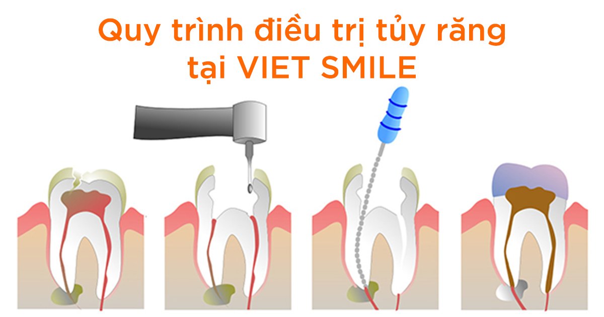 Quy trình điều trị tủy răng tại viet smile