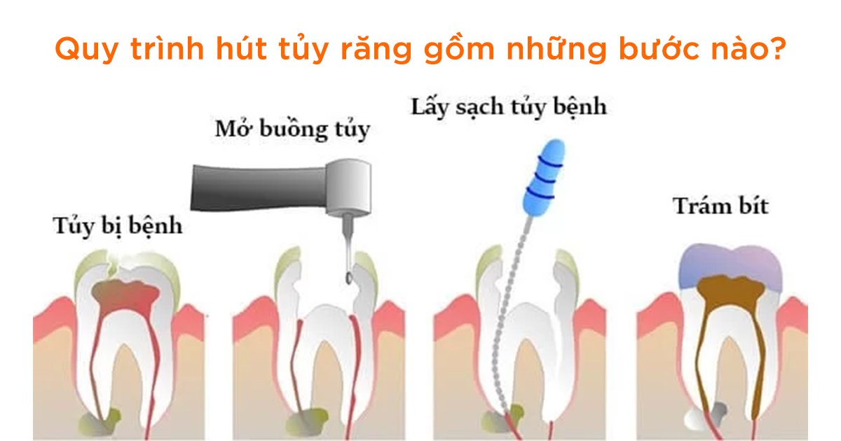 Quy trình hút tủy răng gồm những bước nào?