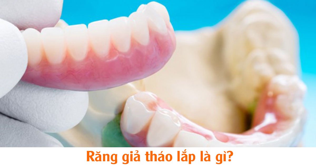Răng giả tháo lắp là gì?