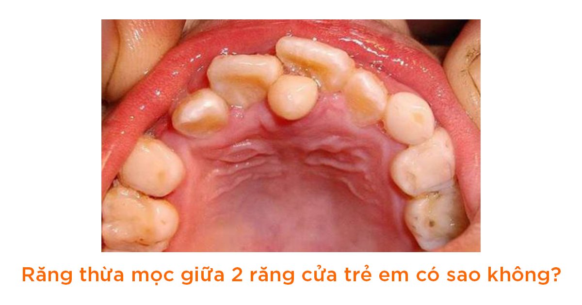 Răng thừa mọc giữa 2 răng cửa ở trẻ em có sao không?