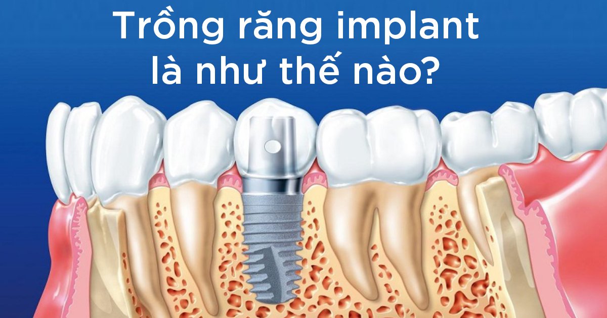 Trồng răng Implant là quá trình như thế nào?