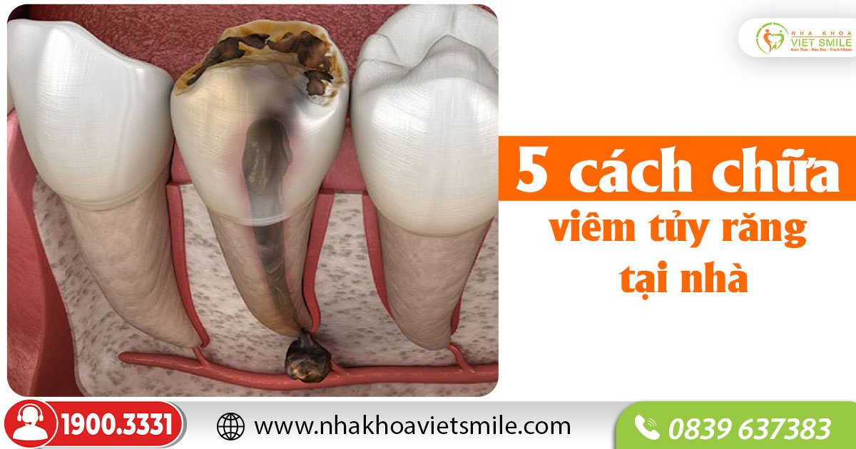 5 cách chữa viêm tủy răng tại nhà