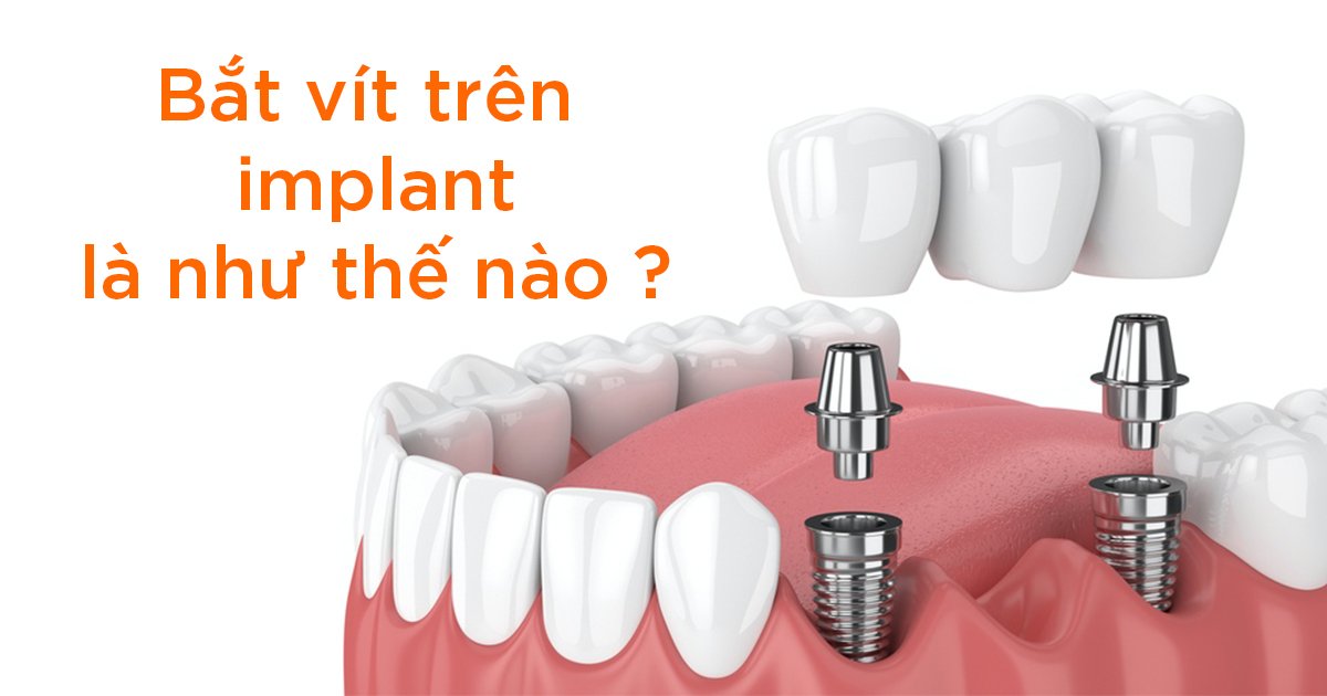 Bắt vít trên implant như thế nào?