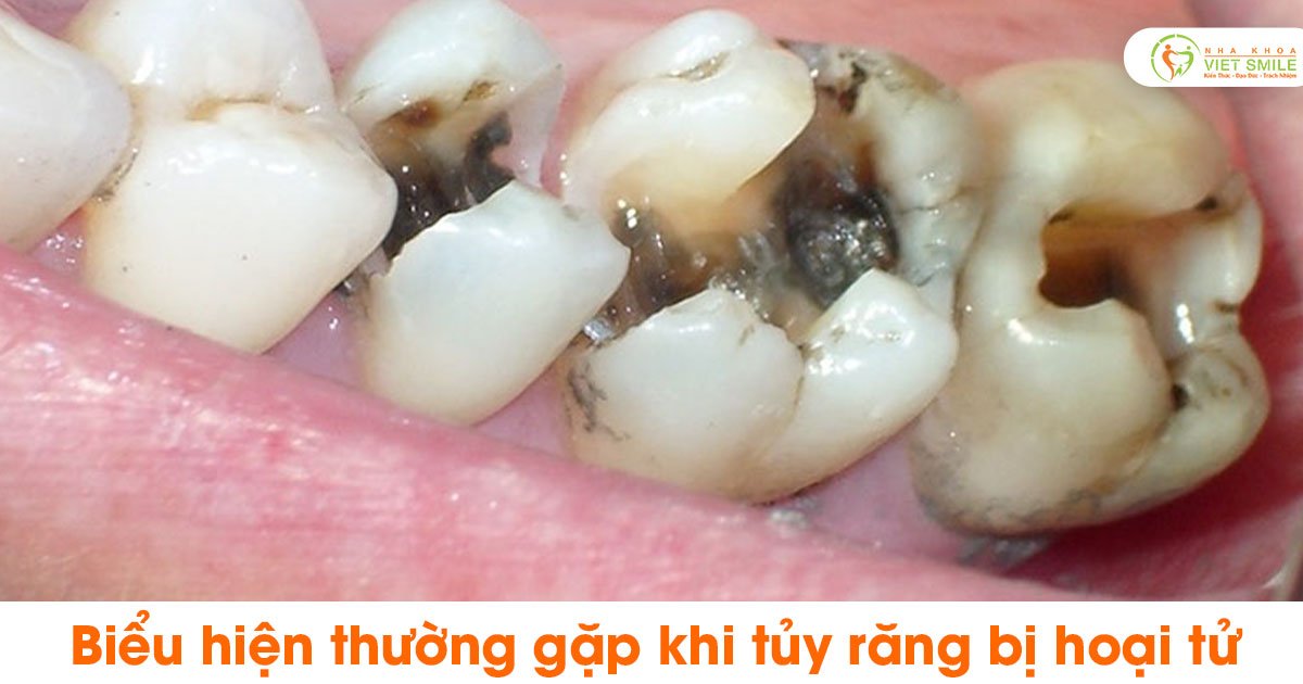 Biểu hiện thường gặp khi tủy răng bị hoại tử