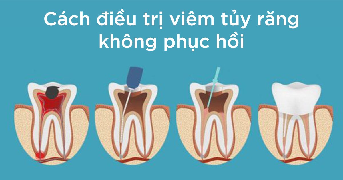 Cách điều trị viêm tủy răng không phục hồi