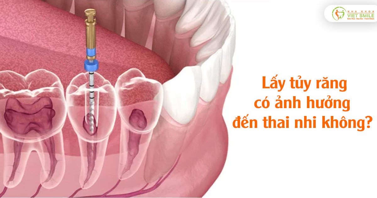Lấy tủy răng có ảnh hưởng đến thai nhi không?