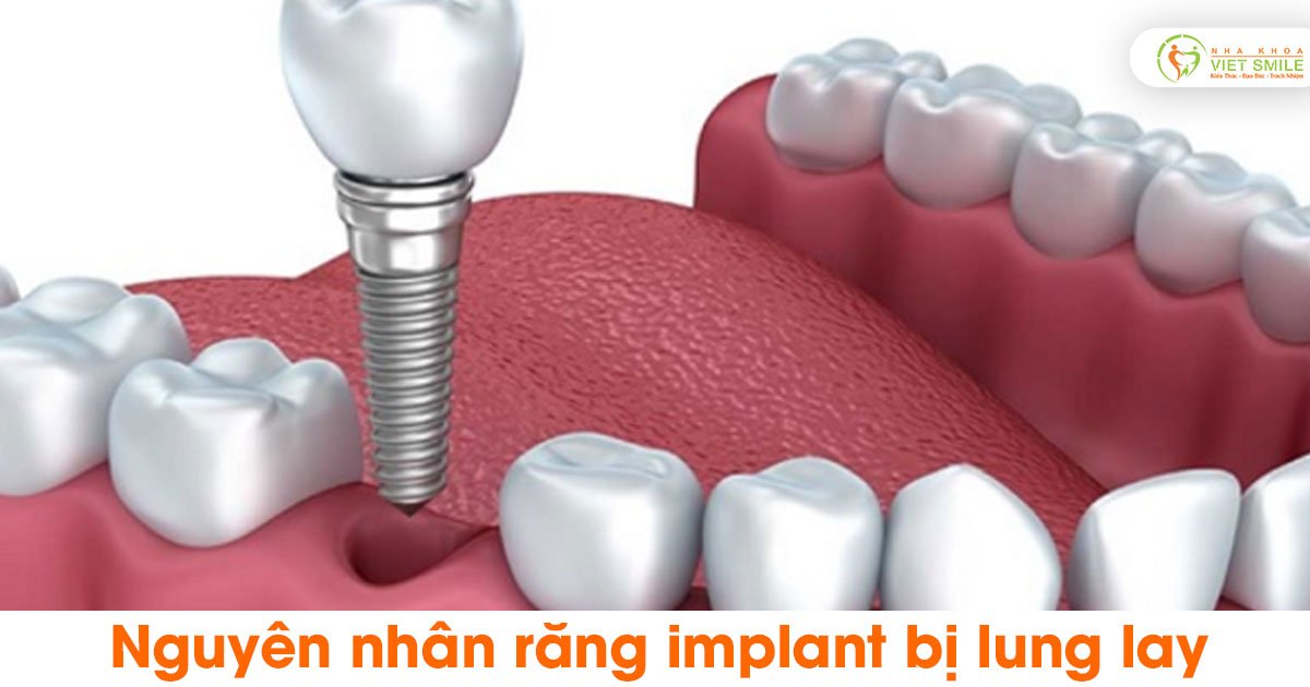 Nguyên nhân răng implant bị lung lay