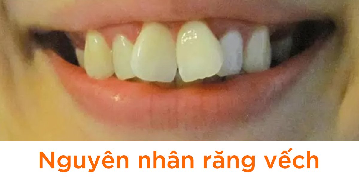 Nguyên nhân răng vếch