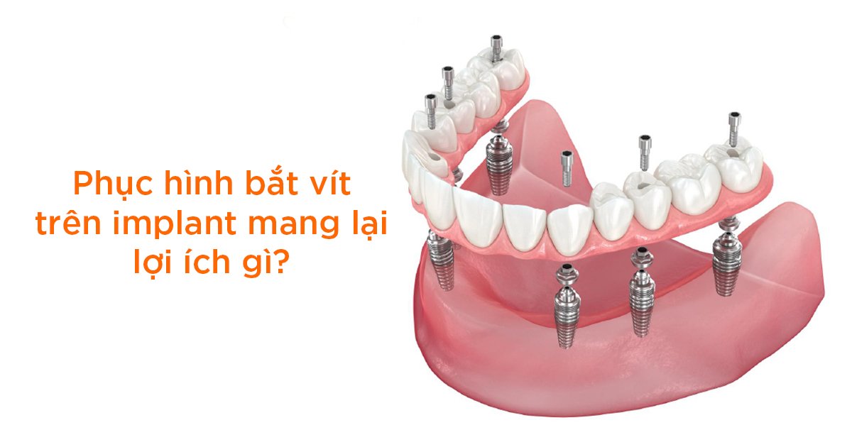 Phục hình bắt vít trên implant mang lại lợi ích gì?