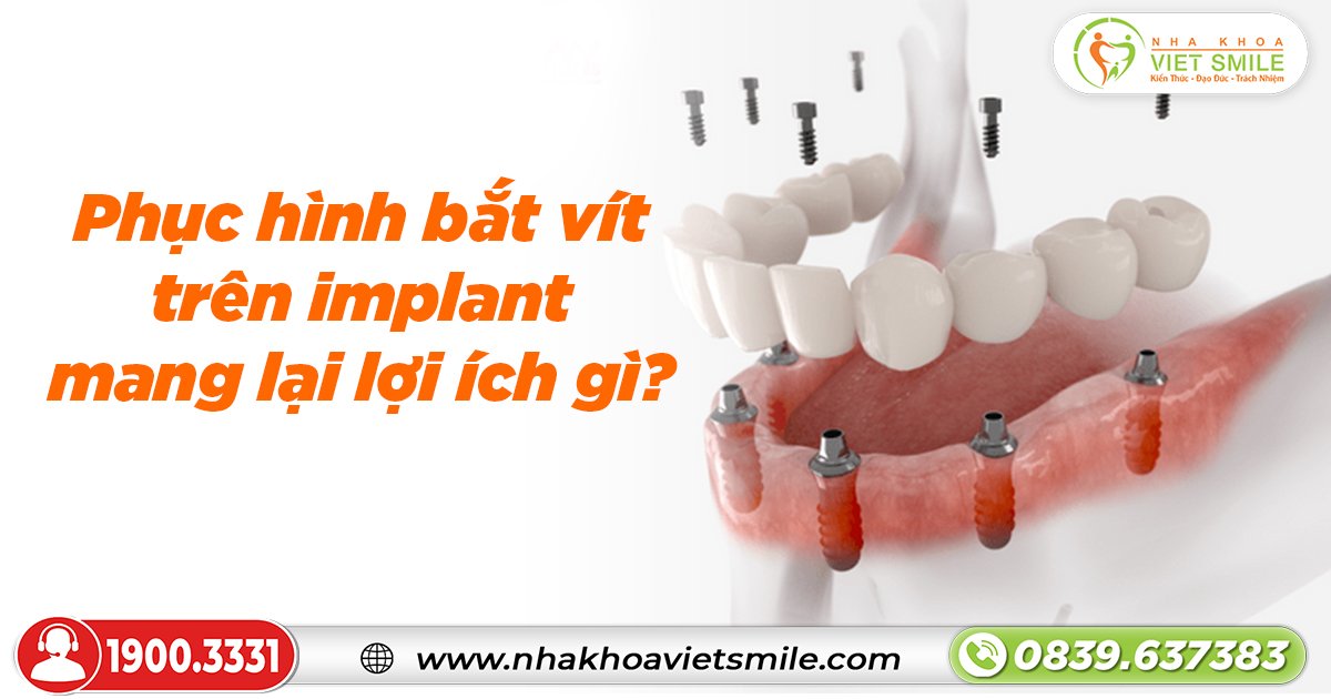 Phục hình bắt vít trên implant mang lại lợi ích gì?