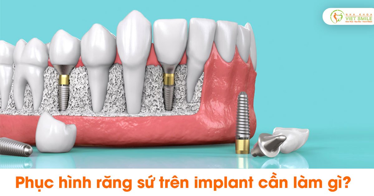 Phục hình răng sứ trên implant cần làm gì?