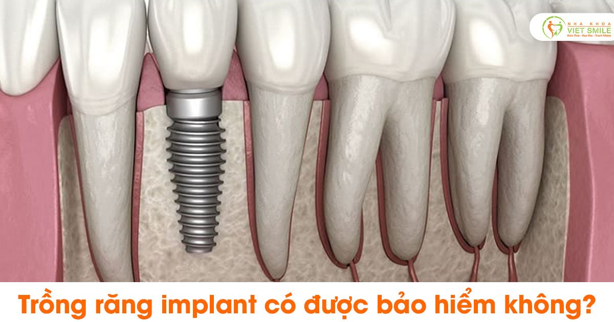 Trồng răng implant có được bảo hiểm không?
