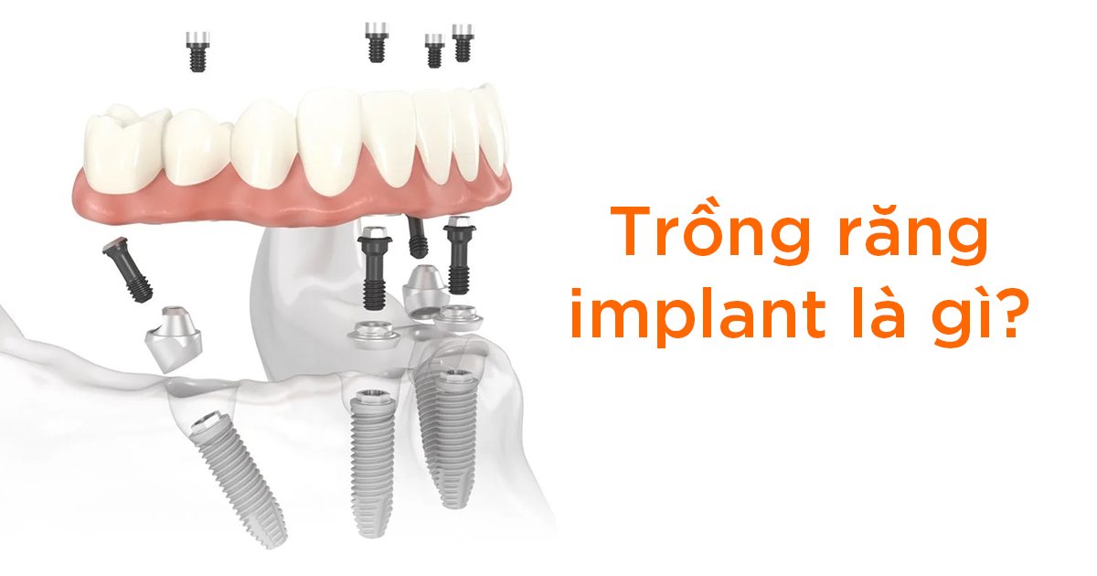 Cấy ghép implant là gì?