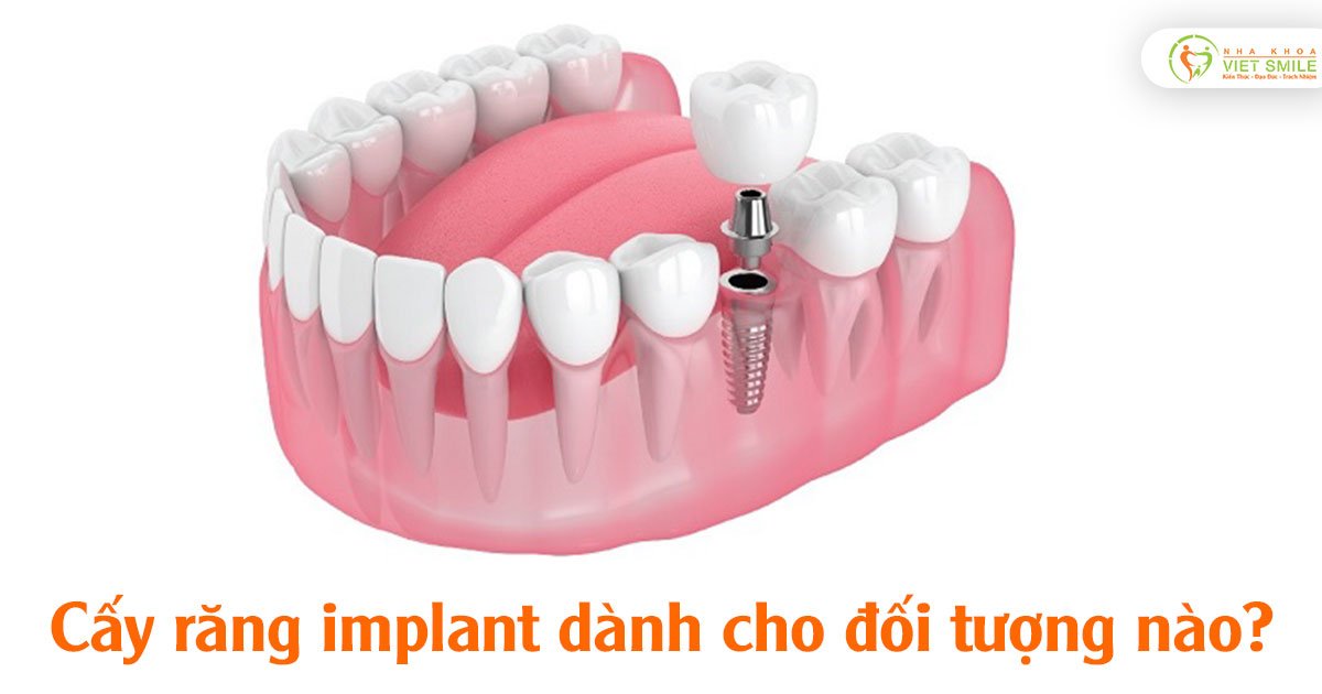 Cấy răng implant dành cho đối tượng nào?