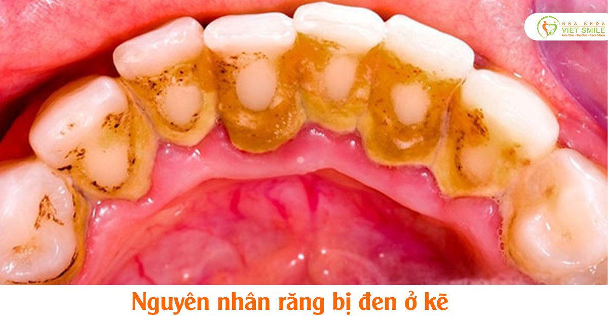 Nguyên nhân răng bị đen ở kẽ