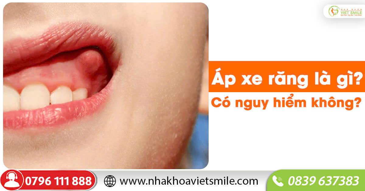 Áp xe răng là gì? Có nguy hiểm không?