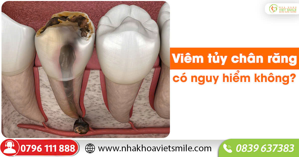 Viêm tủy chân răng có nguy hiểm không?